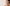Jawline Acne: Hormones, Irritation, and Treatment Options
