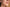 Types of Acne Explained: A Complete Guide to All Acne Types